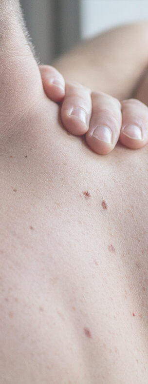Skin Cancer Diagnosis