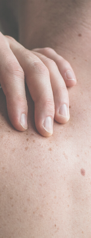 Close-up of a hand touching skin with visible moles and freckles, illustrating areas to monitor for potential skin changes or skin cancer signs