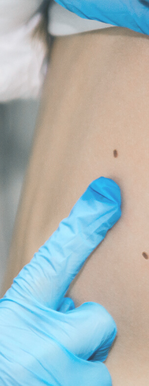 checking mole for skin cnacer