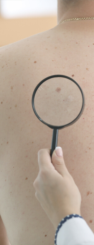 skin cancer test checking for mole