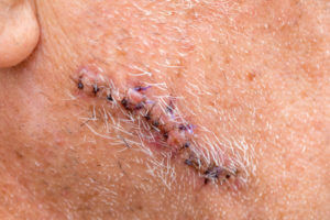 a Mohs surgery incision on a patient's face