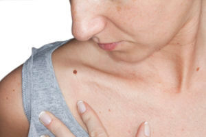 A woman looking to the side at the mole near the v-line of her neck.