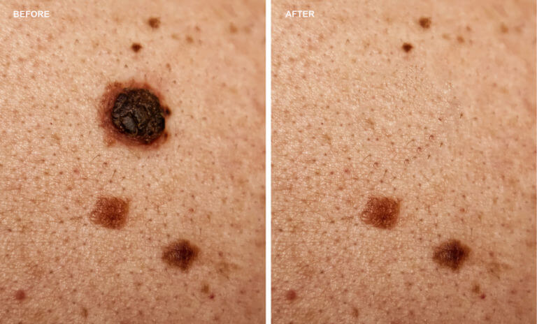 Photo before and after removal of mole on woman skin