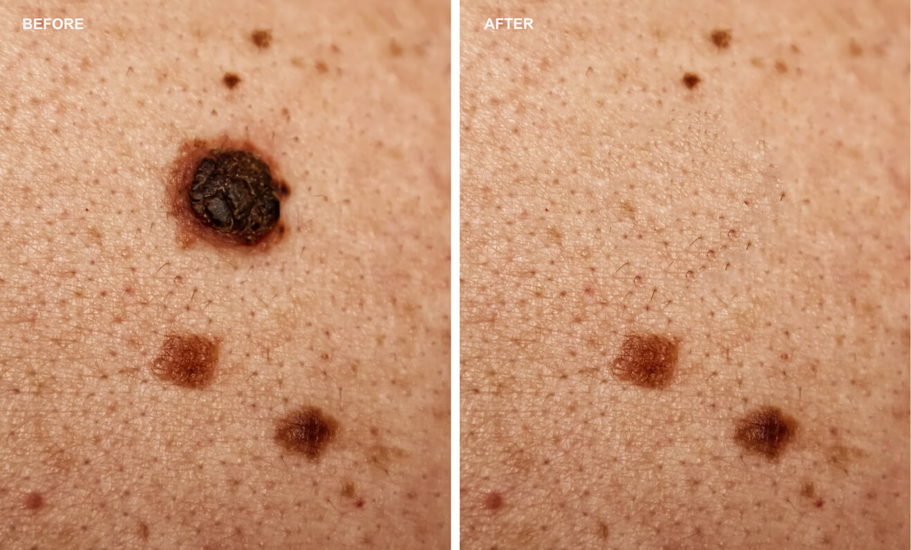 cancerous moles vs normal moles