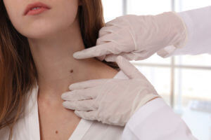 Doctor dermatologist examines mole on patient's neck