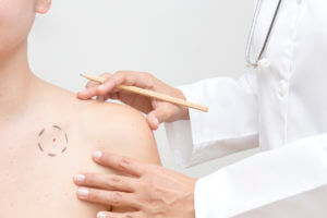 Melanoma Risk