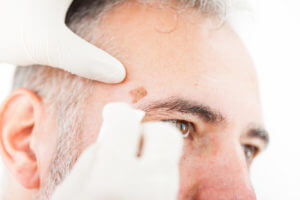Melanoma Diagnosis