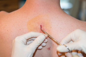 Surgical removal of Basal Cell Carcinoma