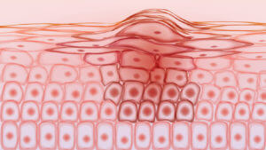 Cancerous skin cells