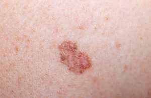 A basal cell carcinoma