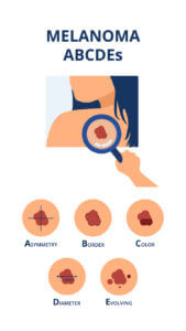 Melanoma Treatment & Diagnosis