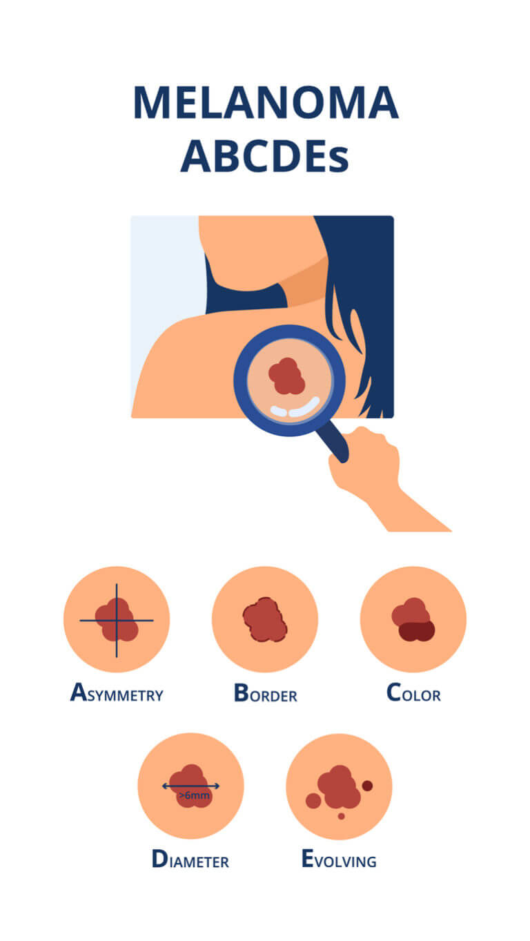 Melanoma Treatment & Diagnosis