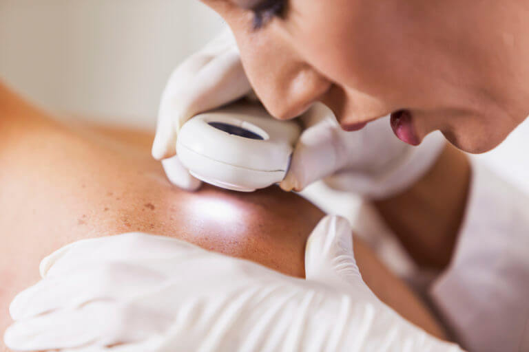 Dermatologist trying to diagnose skin cancer