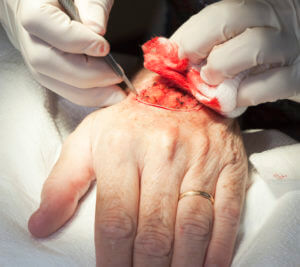 Mohs Surgery Technique