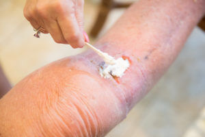 Ointment being applied by Mohs Surgeon after surgery