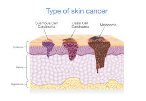 Type Of Skin cancers