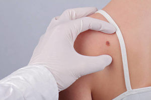 Doctor dermatologist examines birthmark of patient close up. Checking benign moles