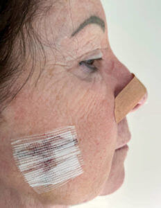 Senior caucasian woman has had mohs surgery on her cheek and a biopsy on her nose.