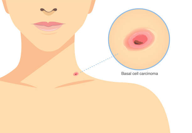 Red bump is Basal cell carcinoma on the woman's neck. Illustration about skin cancer, medical and health checks.