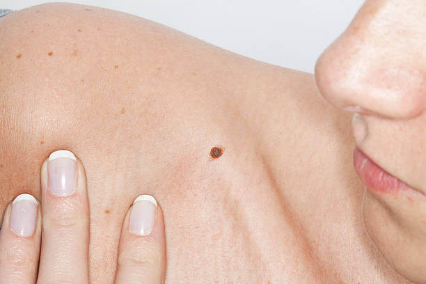 Macro shot of a big skin mole that should be inspected by a dermatologist.