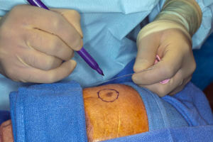 Skin surgeon Doing Surgery