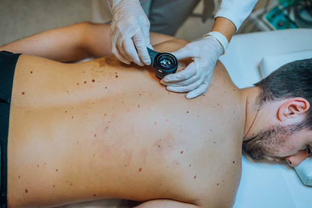 Dermatologist examining patient skin moles with dermoscope at clinic