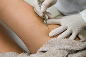 A stock photo of a doctor removing moles on a patients leg with a scalpel.