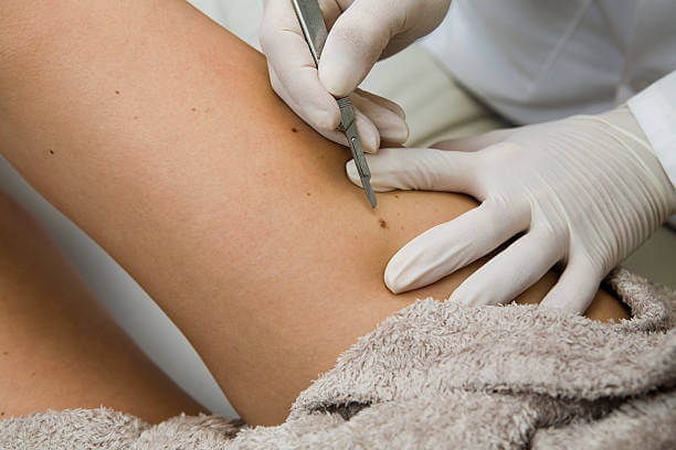 A stock photo of a doctor removing moles on a patients leg with a scalpel.