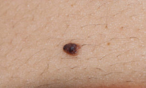 Extreme close up of a skin mole that could potentially be basal cell carcinoma