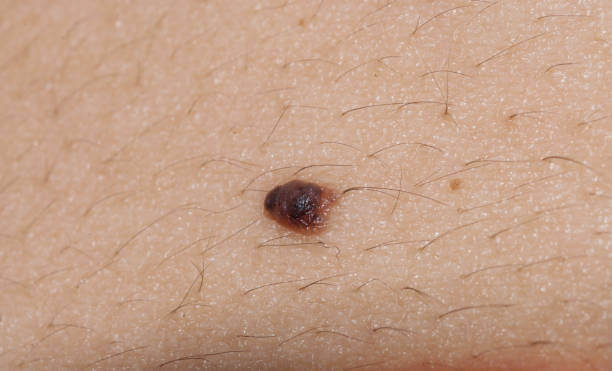 Extreme close up of a skin mole that could potentially be basal cell carcinoma