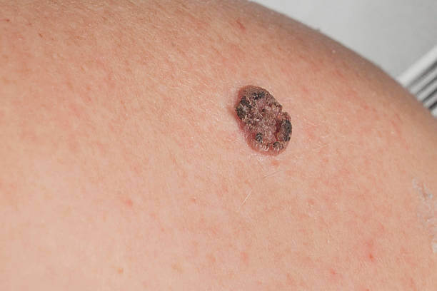 keratinizing squamous cell cancer of the skin on the back of an elderly man