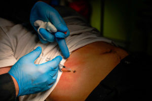 Mole Removal Surgery Procedure By Surgical Dermatologist