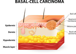 Basal-cell carcinoma