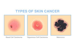 medical diagram of basal cell carcinoma,