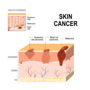 Basal Cell Carcinoma - Dermatology and Skin Cancer Center - Coral Cables FL