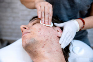 Acne Treatment - Miami