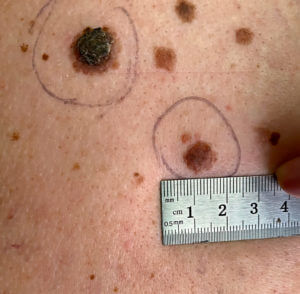 Measuring the size of a mole on human skin