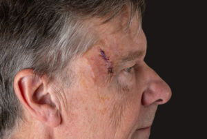 Side view of senior man after MOHS surgery to remove skin cancer stitches in wound.