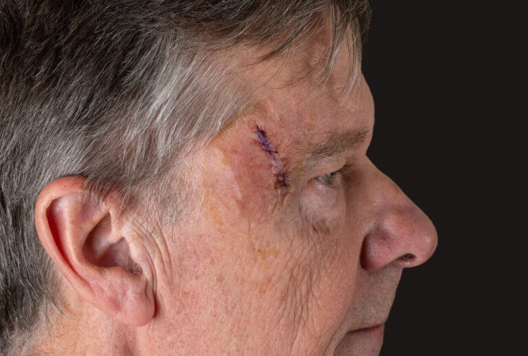 Side view of senior man after MOHS surgery to remove skin cancer stitches in wound.