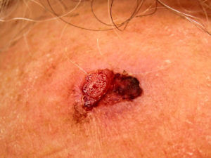 Squamous Cell Carcinoma of the skin.