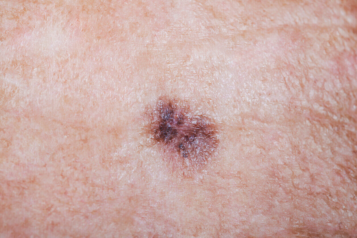 melanotic sarcoma is a skin cancer that begins with Identifying Early-Stage Melanoma Employee Duration:Trial Pack lipo after c section