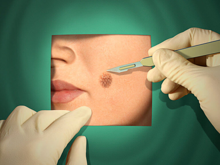 A patient's face is framed by a green surgical drape, revealing a raised brown mole on the cheek