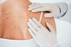 A dermatologist in latex gloves is examining a woman for signs of skin cancer.