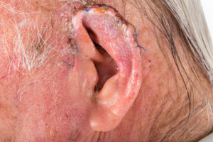 Mohs surgery performed on a man's ear.