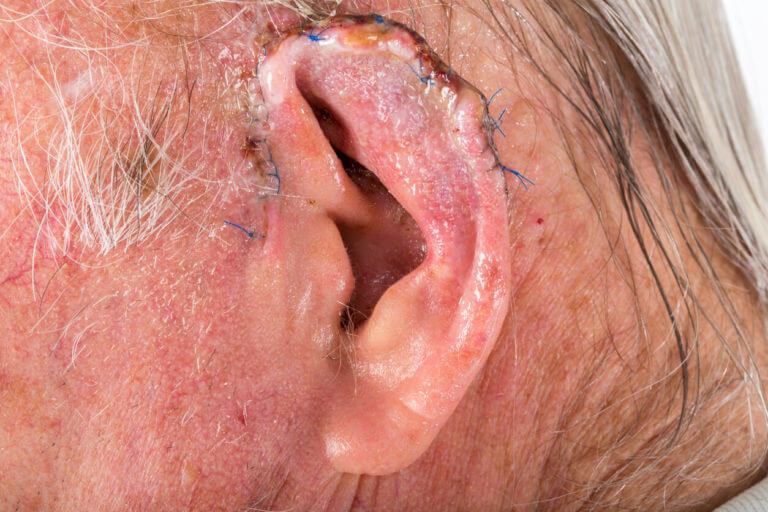Mohs surgery performed on a man's ear.