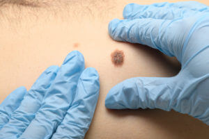 Visual examination of moles for detecting malignant neoplasms to prevent skin cancer and melanoma.