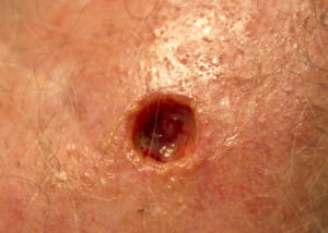 A Mohs surgery procedure for the excision of skin cancer.