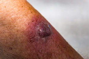 An image of invasive squamous cell carcinoma on the left arm of a patient with squamous cell skin cancer.