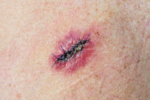 Mohs surgery involving a stitched incision for the removal of a basal cell carcinoma.