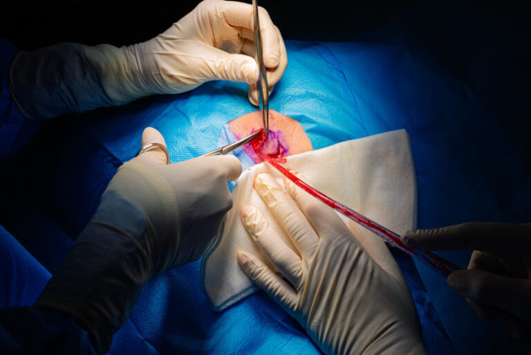 A dermatological surgery is happening in the operating room to remove your skin cancer.